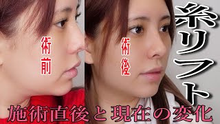 DT公開！糸リフトしてきたよ！