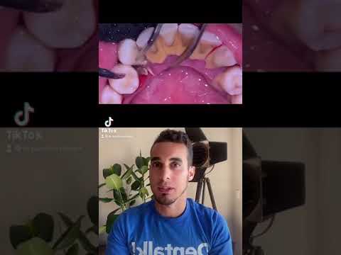 ✅CÓMO QUITAR el SARRO dental en el DENTISTA😷 - Tratamiento rápido y sencillo #shorts