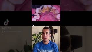 ✅CÓMO QUITAR el SARRO dental en el DENTISTA😷 - Tratamiento rápido y sencillo #shorts