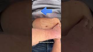How to Assess for Appendicitis: Rovsing's Sign #abdominalpain