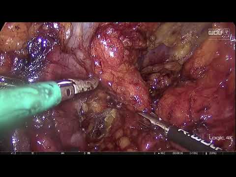 LAPAROSCOPIC LYMPHADENECTOMY DURING RADICAL PROSTATECTOMY...