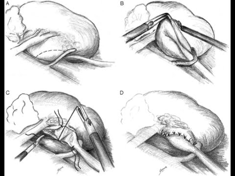 Robotic Pyeloplasty