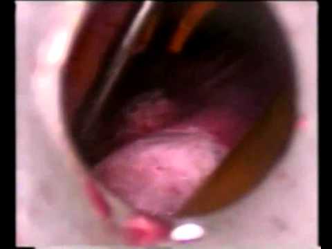 comment soigner kyste