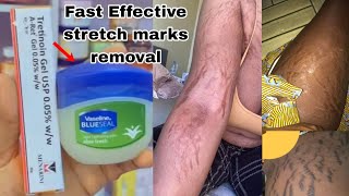 Wirksames Produkt, das Dehnungsstreifen schneller verschwinden lässt / Anwendung der Tretinoincreme