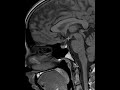 How to read an MRI of the pituitary gland | First Look MRI