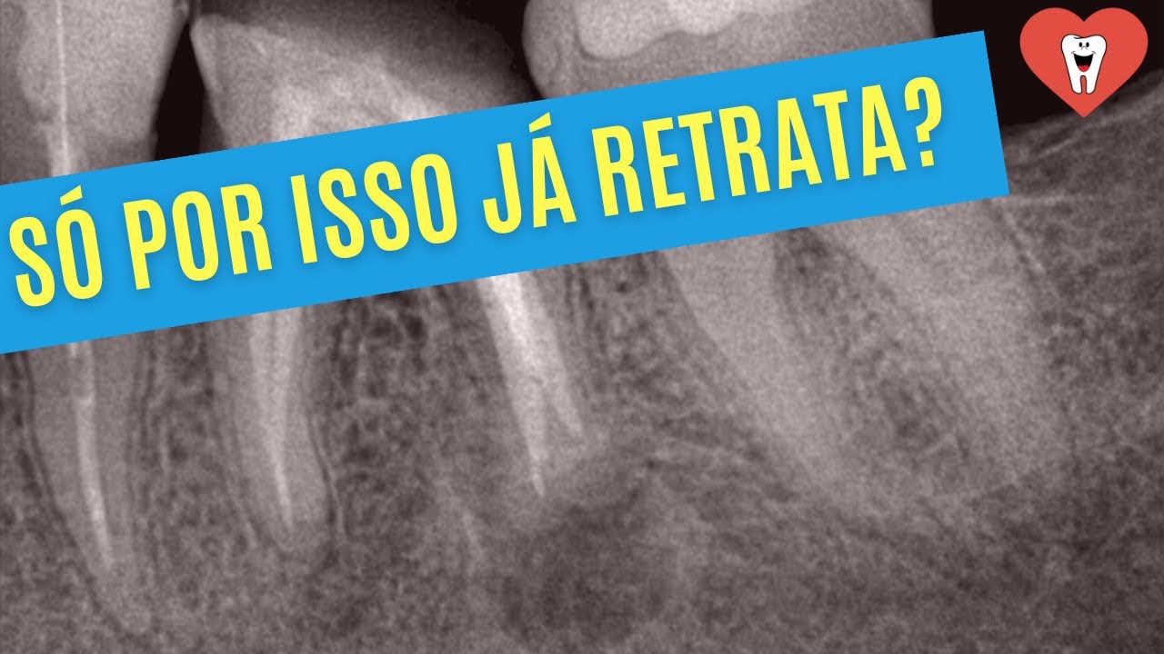 NÃO SAIA RETRATANDO CANAL COM LESÃO ANTES DE TER AVALIADO ISSO!!