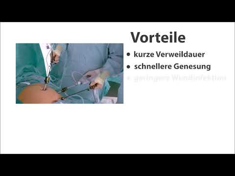 Appendektomie - Präsentation Beispiel - Die Laparoskopie