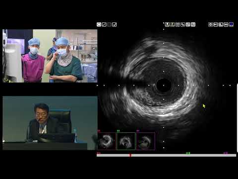 [TCTAP 2017] Coronary Symposium - Live Case & Lecture Session II