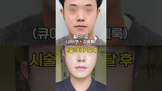 큐어젯+쥬베룩 이 조합으로 흉터 없앴다