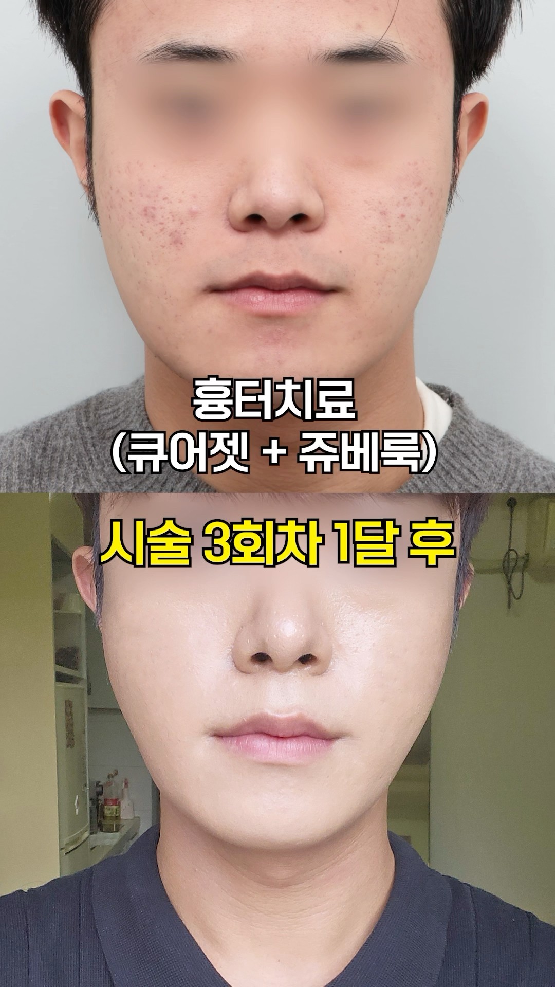 큐어젯+쥬베룩 이 조합으로 흉터 없앴다