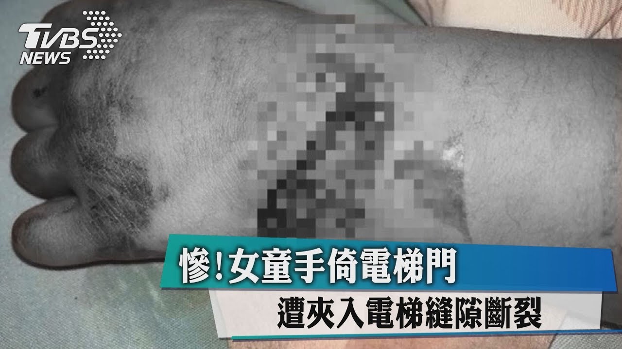慘！女童手倚電梯門　遭夾入電梯縫隙斷裂