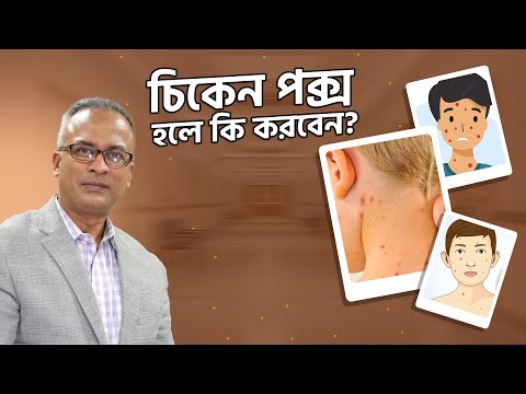 জলবসন্ত কি এবং কেন হয়? প্রতিরোধ আর প্রতিকারের উপায় II Chicken Pox and Health Issues II Drferdousny