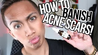 HOW TO GET RID OF ACNE SCARS! | PAUL ZEDRICH