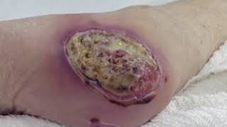 Wound Care Part 3: Types of Wounds