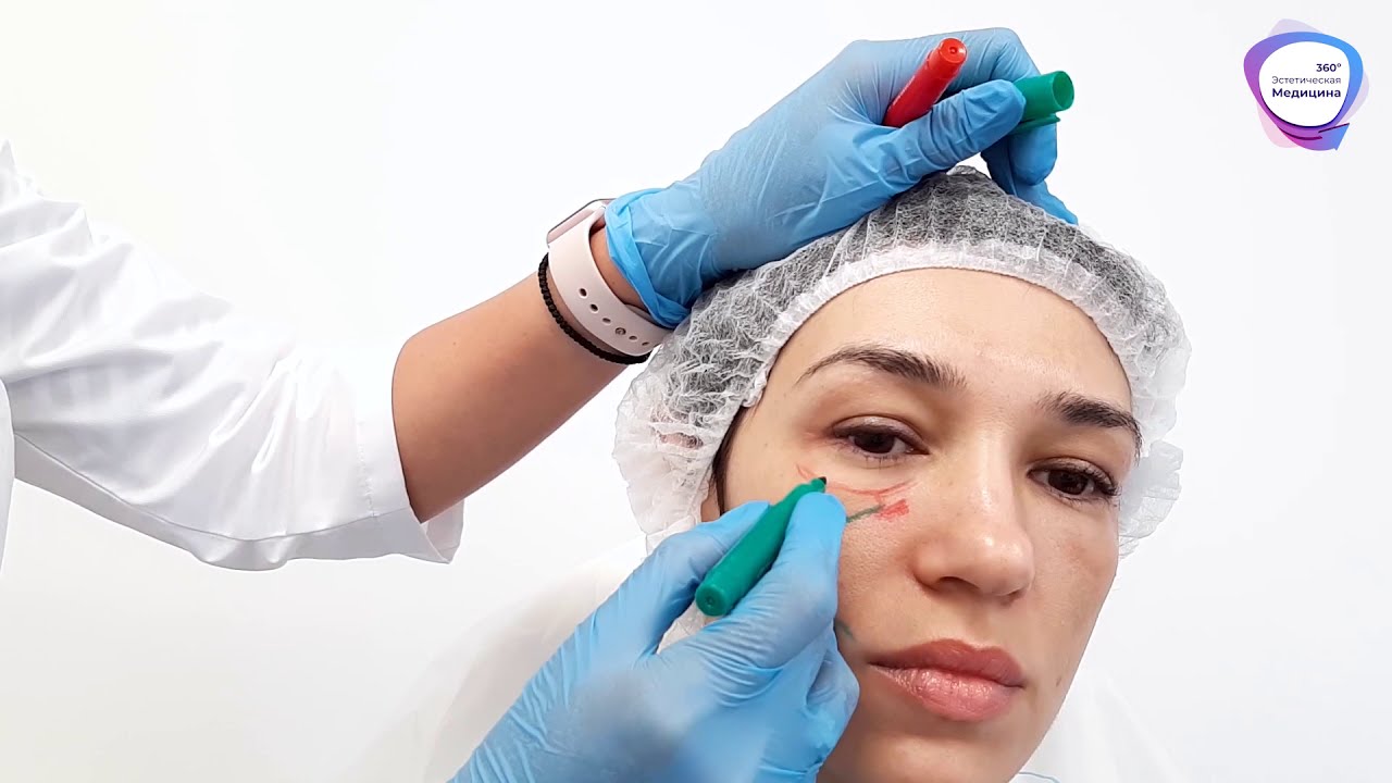 Векторный Лифтинг Лица ► Филлер Radiesse