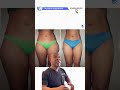 LIPO OF LATERAL THIGHS AND INNER THIGHS