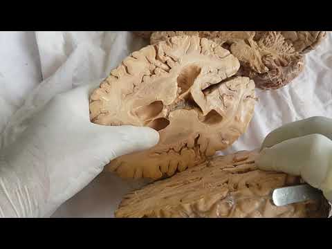 Sections of brain - gross anatomy