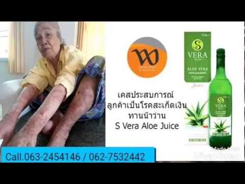ครีมกลากคิดเห็น aliekspress อาการกลากเฉียบพลัน
