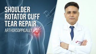 कंधे के मास फटने का दूरबीन द्वारा सफल ऑपरेशन  Rotatator cuff repair Arthoscopically