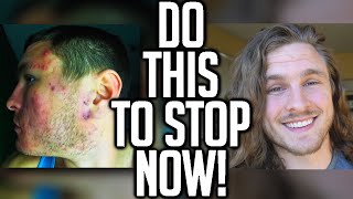 How To Stop Picking At Your Acne QUICKLY! | DERMATILLOMANIA
