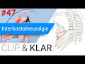 Interkostalneuralgie Erklärt Zwischen Rippen Nervenschmerz