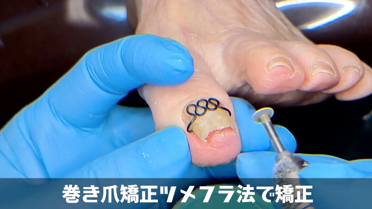 分厚い巻き爪！娘さんに連れられ、巻き爪矯正を初体験！【感激体験】