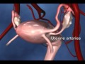 Abdominal Hysterectomy