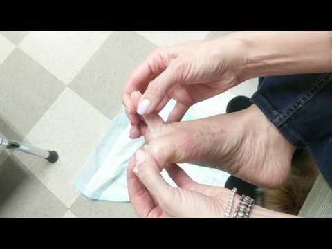 Post Bunionectomy Exercise