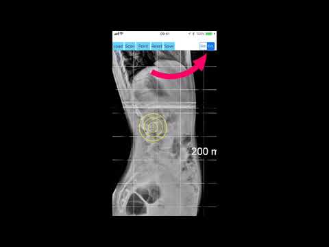 How to measure Spinopelvic balance with the App by Orthopractis.com