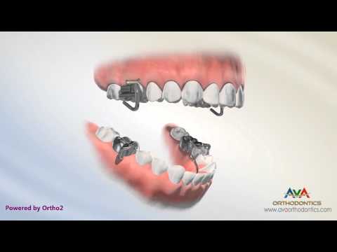 Orthodontic Treatment for Overjet (Overbite) - MARA Appliance