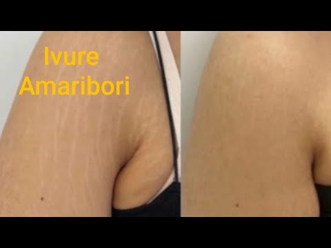 Umuti wamaribori nawe wakwikuriraho amaribori mugihe gito