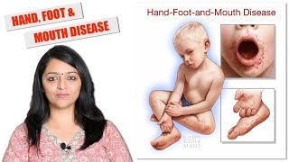 HAND FOOT MOUTH DISEASE | बच्चों में हाथ, पैर और मुँह का रोग | HFM