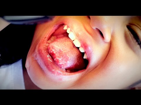 Kuko halamang-singaw laser paggamot sa Moscow, mga presyo at mga review Treat kuko pasa sa kanyang binti