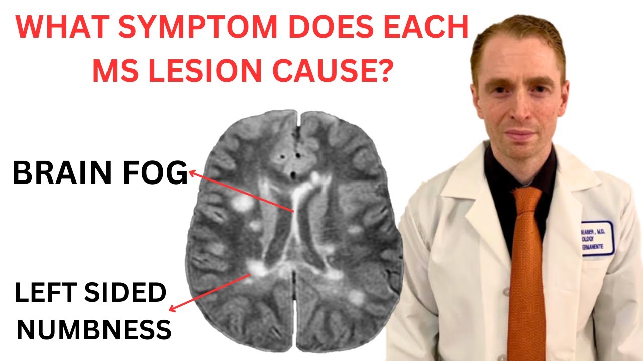 What Symptom Does Each Multiple Sclerosis MRI Lesion Cause?  Neurologist Explains