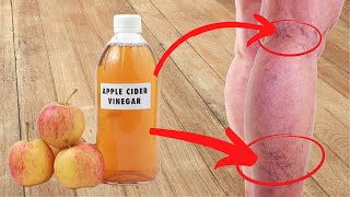 Apple cider vinegar for varicose veins as remedy No.1