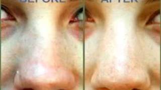 In the Operating Room – Incision Approach for Revision Rhinoplasty
