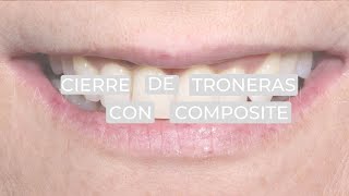 Sabías qué - Cierre de troneras con composite