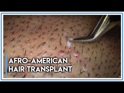 Afro-American Hair Transplant Follicular Unit...