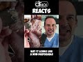 Doctor Reacts Shaving HUGE Foot Callus Shorts