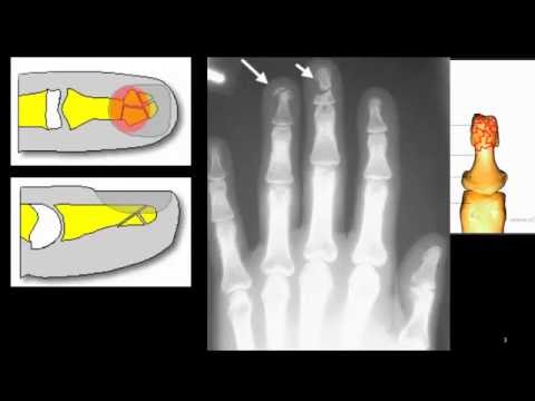 Fracture of distal finger tip