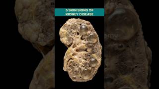 5 Skin Signs of Kidney Disease You Shouldn’t Ignore 🚨 #kidneydisease