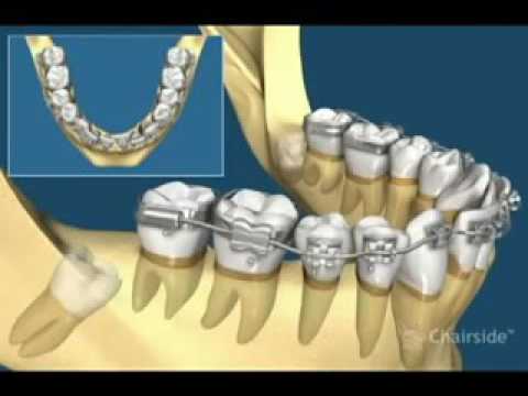 Impacted Wisdom Teeth Removal Animation