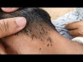How to comb head lice - Clear thousand head lice quickly