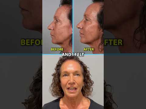 INCREDIBLE Lip Lift Result