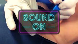 Hear and See Giant Cyst on Chest Squirt on Patient Mp4 3GP & Mp3