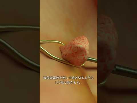 大腸EMR
