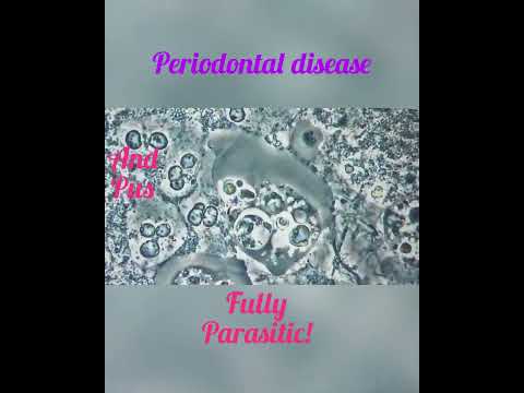 periodontitis, cure gum disease