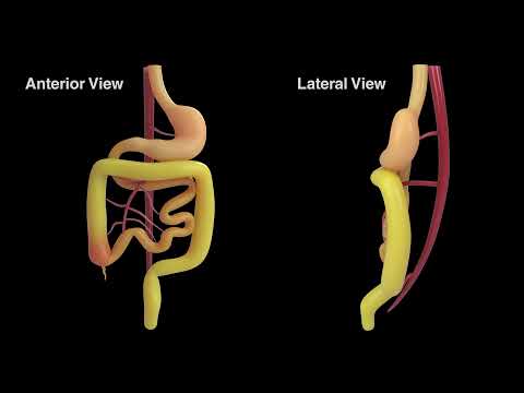 New Revelations in the Pathophysiology and Surgical Management of Congenital Gut Malrotation