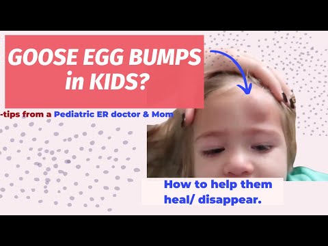 How to treat Goose Egg Bumps | Pediatrician explains