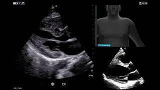Vscan Airu2122 | Caption AIu2122 cardiac interpretation u2013 Automated Ejection Fraction (AutoEF)